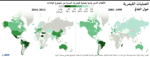 اطباء يحذرون من "آفة العمليات القيصرية"